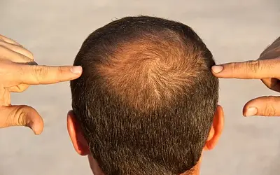 Τριχόπτωση: Οι τύποι, οι αιτίες και τι να κάνετε!