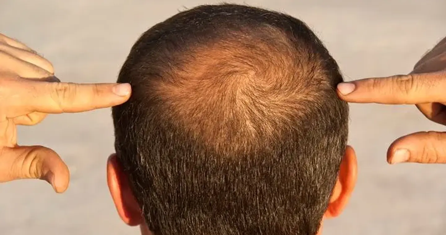 Οι 3 τύποι τριχόπτωσης και οι θεραπείες που πραγματικά βοηθούν