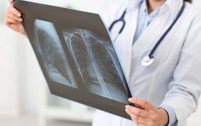 Η φυματίωση «χτυπά» ακόμα: Συναγερμός για 1,23 εκατ. θανάτους το 2024