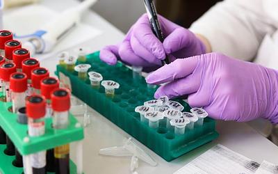 Λύκος: Νέα αμερικανική μελέτη συνδέει την ασθένεια με τον ιό Epstein-Barr