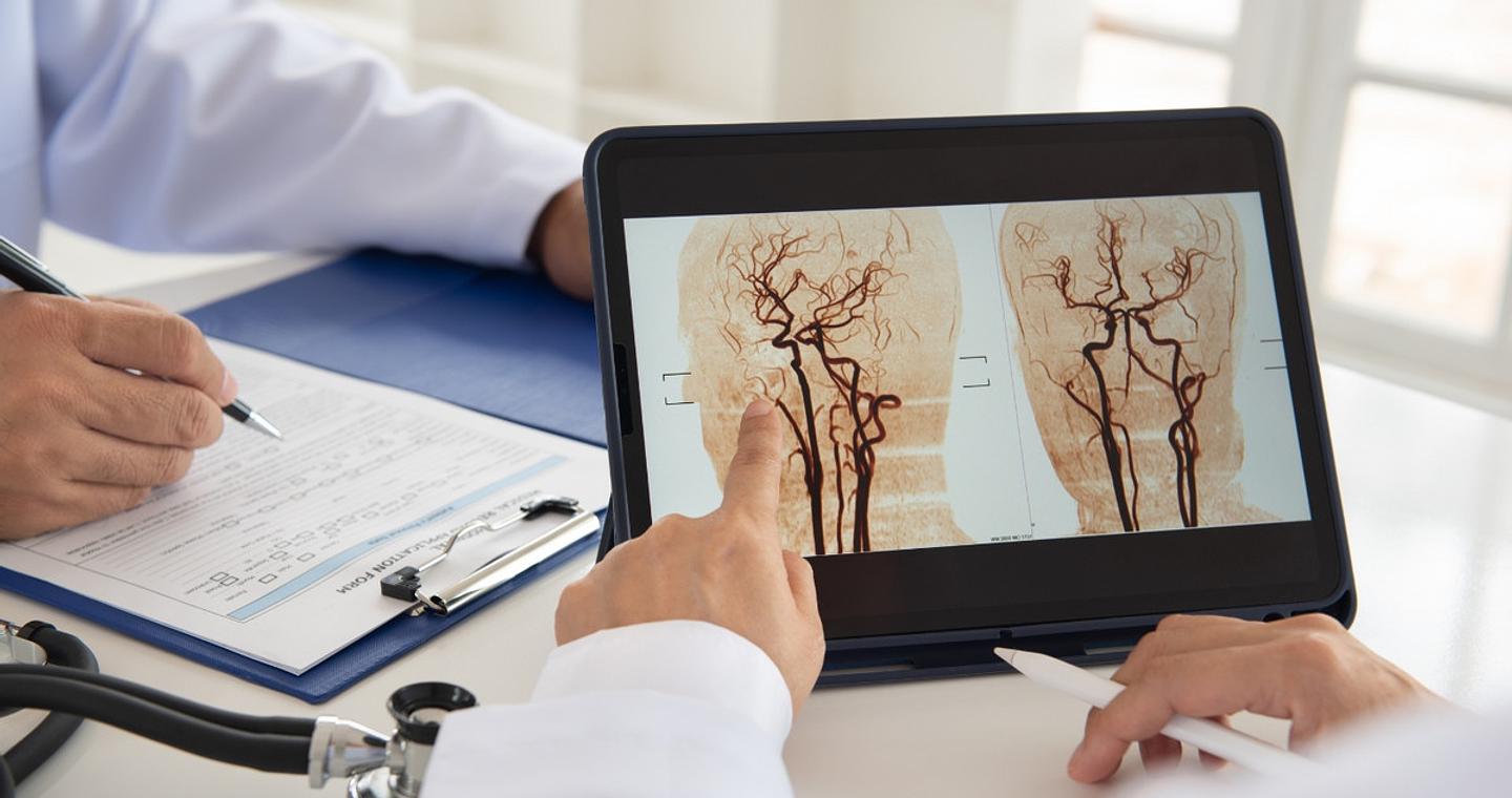 Εγκεφαλικό και ανεύρυσμα: Ποια είναι η διαφορά