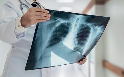 Ακτινογραφίες και αξονικές: Πόσο αυξάνουν τον κίνδυνο καρκίνου;