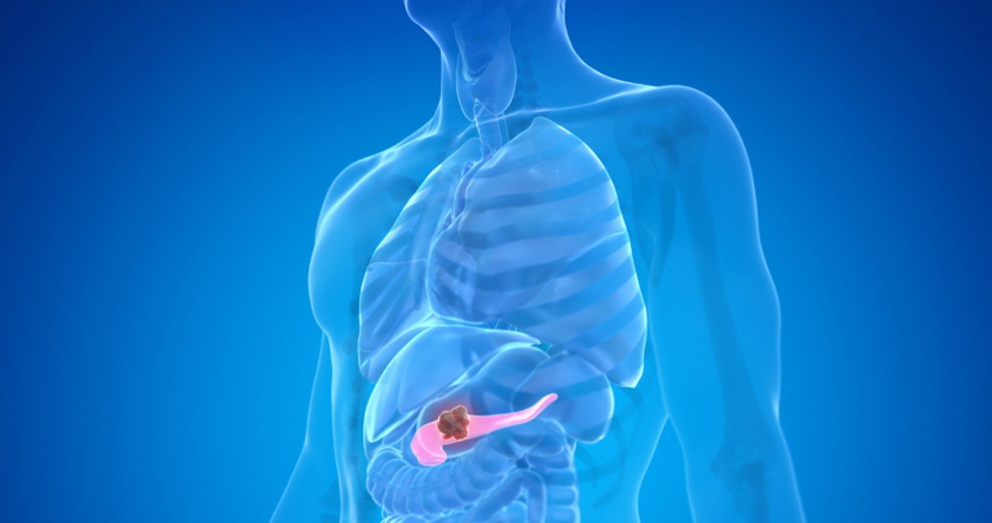 Καρκίνος του παγκρέατος: Πρωτοποριακή έρευνα αποκάλυψε γονιδιακά μοτίβα που σχετίζονται με τη νόσο
