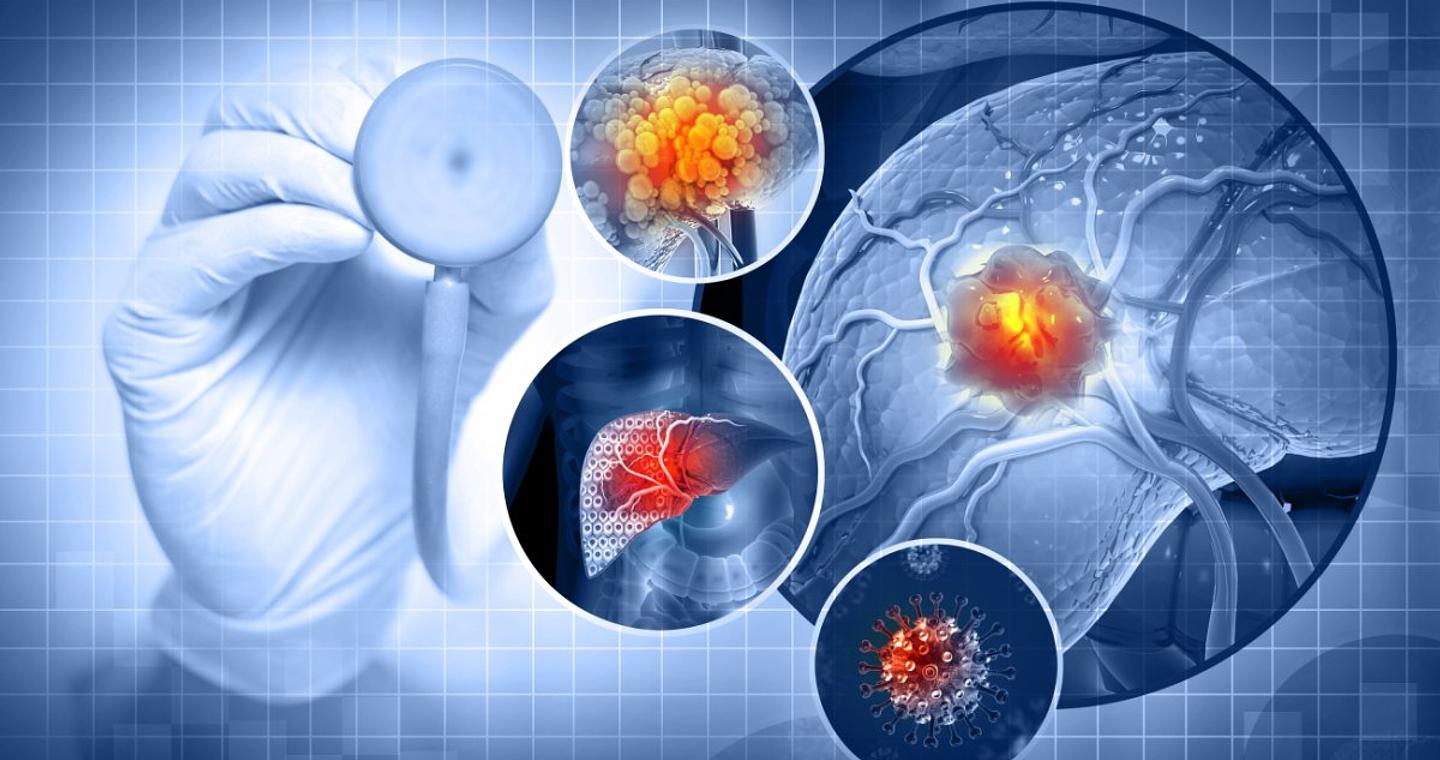 Η λιπαρή διατροφή αυξάνει τον κίνδυνο καρκίνου του ήπατος, έδειξε νέα έρευνα