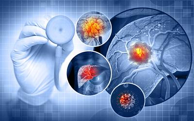 Καρκίνος στο ήπαρ: Η διατροφή «κλειδί» που αυξάνει τον κίνδυνο!