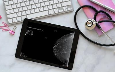 Καρκίνος μαστού: Νέος τρόπος πρόληψης σώζει ζωές – Τι αλλάζει;