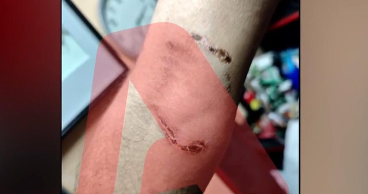 Ομόνοια: Νεαρός έβαλε το πίτμπουλ του να επιτεθεί σε 30χρονο για να τον ληστέψει - «Με έριξε κάτω και το σκυλί με δάγκωνε»