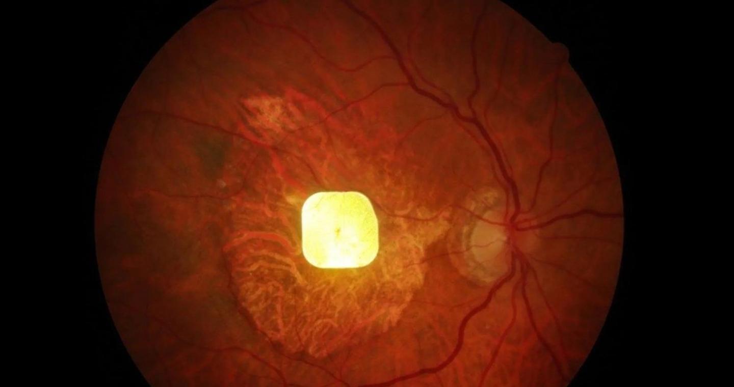 Ασύρματο εμφύτευμα στον αμφιβληστροειδή προσέφερε όραση σε τυφλά άτομα