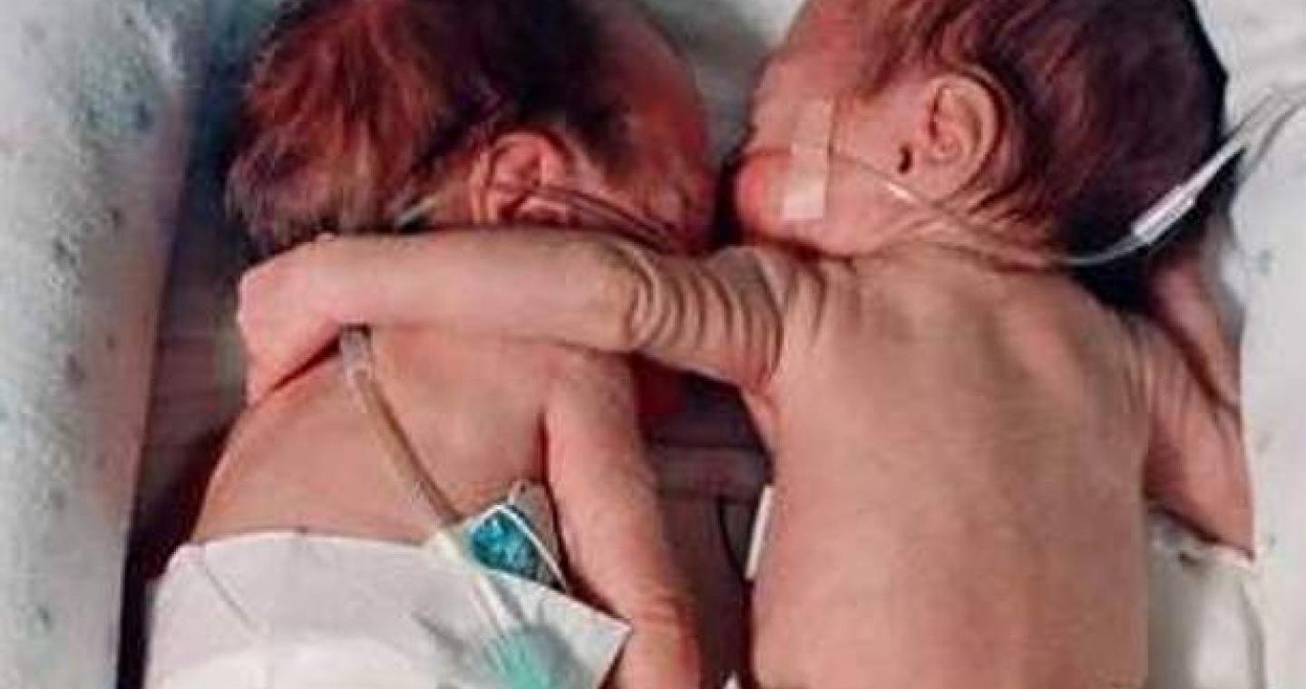 Καρκίνος μεταφέρθηκε από το ένα δίδυμο στο άλλο πριν από τη γέννηση - Τι έδειξε νέα μελέτη