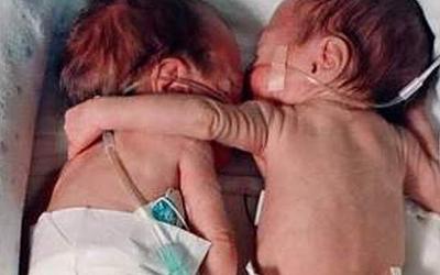 Αποκαλύπτεται: Καρκινικά κύτταρα «ταξίδεψαν» μεταξύ διδύμων στη μήτρα